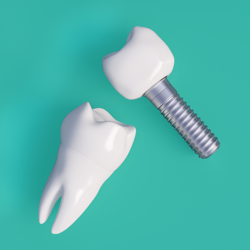 Dental Implants – Vivid Dental